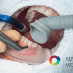 Limpeza de mangueiras de sucção odontológicas com detergente desincrustante, prevenindo biofilmes, entupimentos e refluxo de saliva contaminada em consultórios odontológicos.