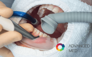 Limpeza de mangueiras de sucção odontológicas com detergente desincrustante, prevenindo biofilmes, entupimentos e refluxo de saliva contaminada em consultórios odontológicos.