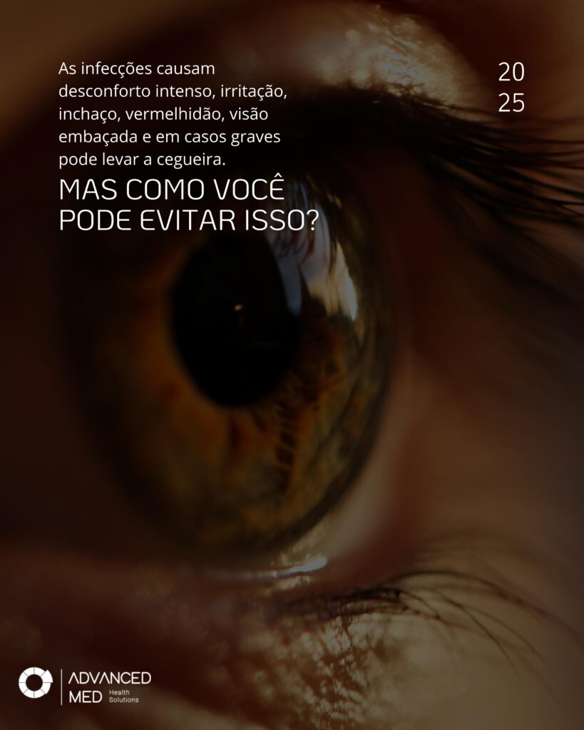 Close de olho com sinais de irritação ocular, representando o aumento de infecções oculares e conjuntivite causadas por falta de higienização correta em procedimentos de extensão de cílios. Imagem da Advanced Med destacando a importância do uso do Pré-Limpeza SMART e Detergente Hospitalar SMART para a biossegurança na estética, especialmente para lash designers e esteticistas.