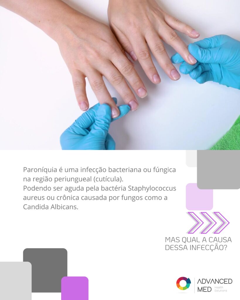 Caso real de Paroníquia após manicure, causado por falhas na biossegurança e limpeza inadequada de instrumentos.